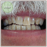 Smile Gallery In Office Teeth Whitening After