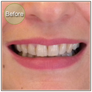 Smile Gallery In Office Teeth Whitening Before Photo Before