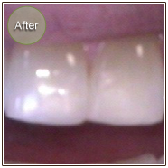 Smile Gallery Composite Restoration After