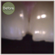 Smile Gallery Composite Restoration Before