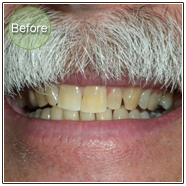 Smile Gallery In Office Teeth Whitening Before Photo