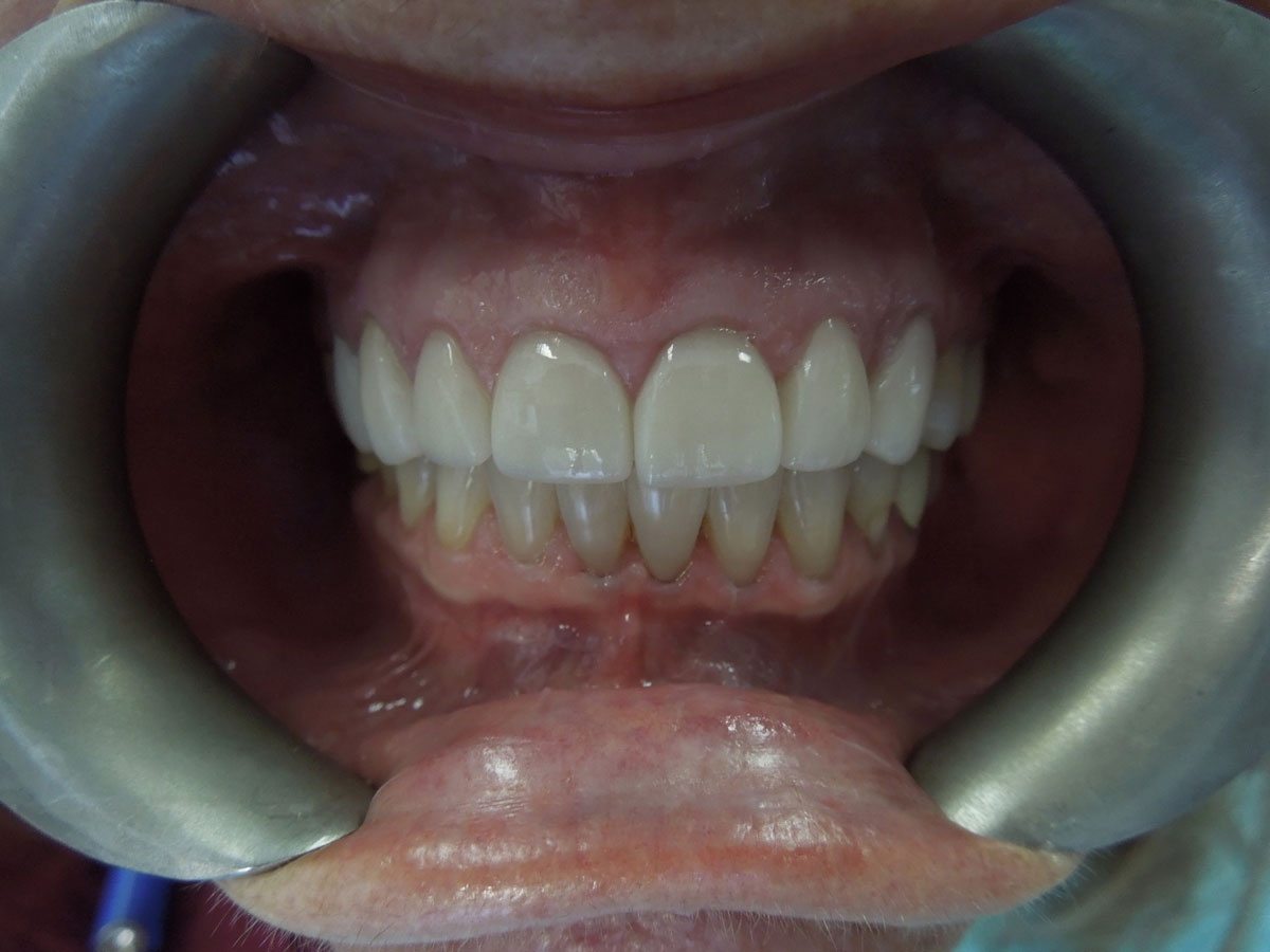 Smile Gallery Veneers After