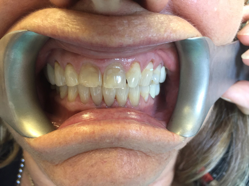 Smile Gallery Veneers Before
