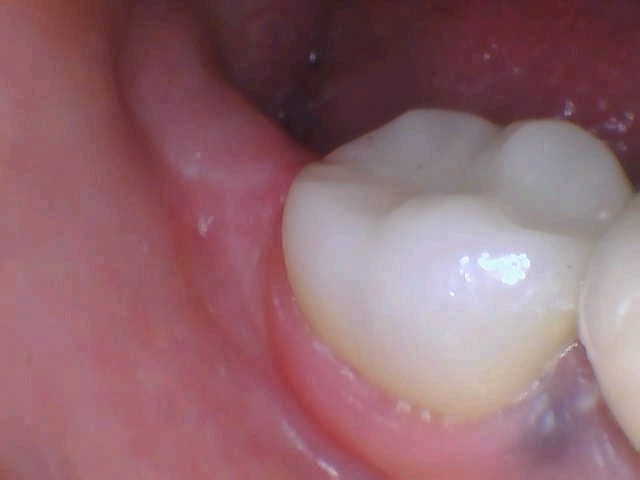 Smile Gallery Fractrured Amalgam Restoration After
