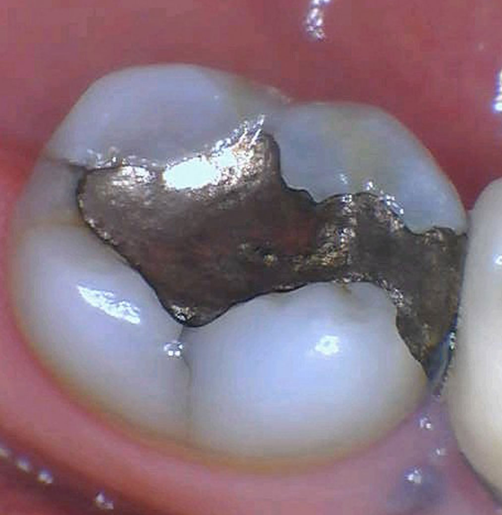 Smile Gallery Fractrured Amalgam Restoration Before